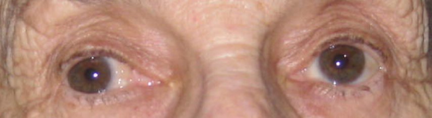Adult Strabismus - Pediatric Ophthalmic Consultants