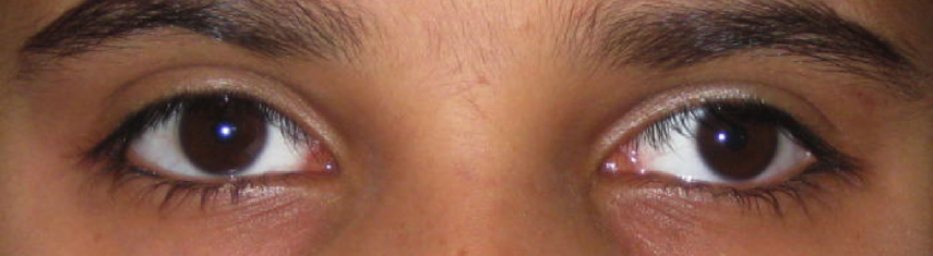 Exotropia Pediatric Ophthalmic Consultants