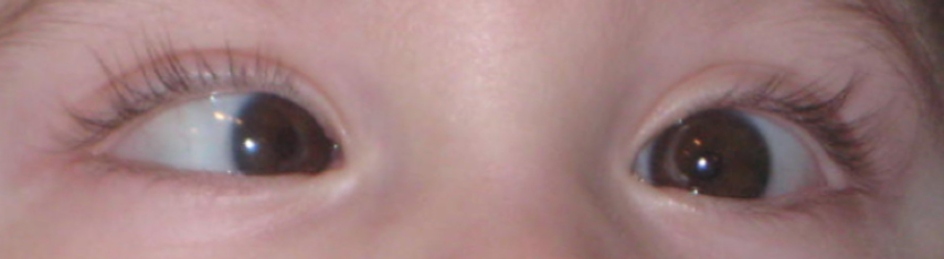 Esotropia (Crossed Eyes) - Pediatric Ophthalmic Consultants