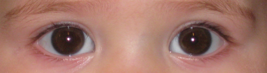 Esotropia (Crossed Eyes) - Pediatric Ophthalmic Consultants