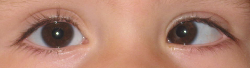 Esotropia (Crossed Eyes) - Pediatric Ophthalmic Consultants