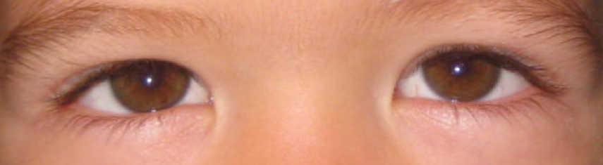 Esotropia (Crossed Eyes) - Pediatric Ophthalmic Consultants