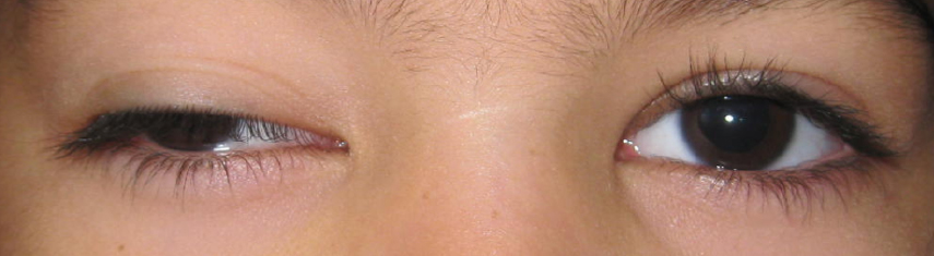 Third Nerve Palsy - Pediatric Ophthalmic Consultants